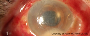 Cataract resource center